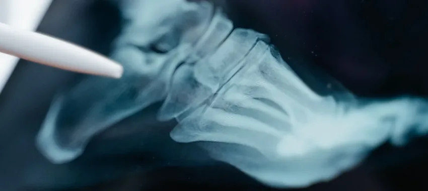 Foot X-ray showing the bones and structure of the foot